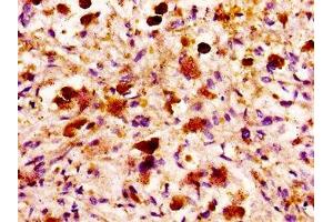 IHC image of ABIN7158974 diluted at 1:100 and staining in paraffin-embedded human melanoma performed on a Leica BondTM system. (MASP2 anticorps  (AA 189-314))