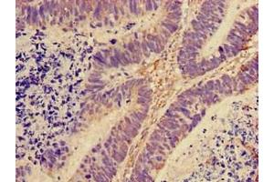 Immunohistochemistry of paraffin-embedded human ovarian cancer using ABIN7142793 at dilution of 1:100 (RPL28 anticorps  (AA 2-137) (Biotin))