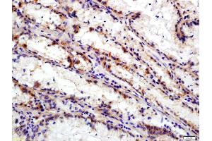 Formalin-fixed and paraffin embedded human gastric carcinoma labeled with Anti-Integrin Alpha V + Beta 6 Polyclonal Antibody, Unconjugated (ABIN714806) at 1:200 followed by conjugation to the secondary antibody and DAB staining (ITGAV/ITGB6 anticorps)
