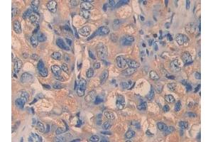 Detection of ITGb1 in Human Breast cancer Tissue using Polyclonal Antibody to Integrin Beta 1 (ITGb1)