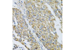 Immunohistochemistry of paraffin-embedded human lung cancer using CYP1A1 antibody (ABIN5971186) at dilution of 1/100 (40x lens). (CYP1A1 anticorps)