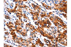 The image on the left is immunohistochemistry of paraffin-embedded Human lung cancer tissue using ABIN7192314(SEPT4 Antibody) at dilution 1/50, on the right is treated with synthetic peptide. (Septin 4 anticorps)