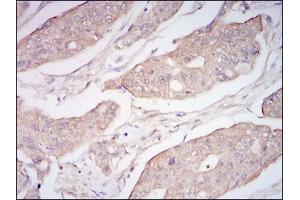 Immunohistochemical analysis of paraffin-embedded rectum cancer tissues using CD10 mouse mAb with DAB staining. (MME anticorps  (AA 52-246))