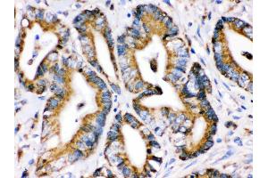 Anti- Grp75 Picoband antibody,IHC(P) IHC(P): Human Intestinal Cancer Tissue