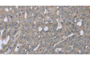 Immunohistochemistry of paraffin-embedded Human ovarian cancer tissue using BMX Polyclonal Antibody at dilution 1:30 (BMX anticorps)