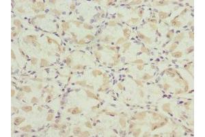 Immunohistochemistry of paraffin-embedded human gastric cancer using ABIN7165131 at dilution of 1:100 (Nerve Growth Factor Receptor (TNFRSF16) Associated Protein 1 (NGFRAP1) (AA 1-111) anticorps)