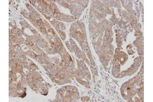 IHC-P Image Immunohistochemical analysis of paraffin-embedded N87 xenograft, using USP15, antibody at 1:100 dilution. (USP15 anticorps  (C-Term))