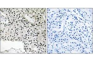 Immunohistochemistry analysis of paraffin-embedded human breast carcinoma, using TCEAL4 Antibody. (TCEAL4 anticorps  (AA 166-215))