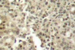 Immunohistochemistry (IHC) analyzes of PKC delta antibody in paraffin-embedded human breast carcinoma tissue. (PKC delta anticorps)