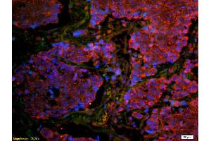 Formalin-fixed and paraffin embedded human lung carcinoma labeled with Anti-CD8B Polyclonal Antibody, Unconjugated (ABIN1387300) at 1:200 followed by secondary antibody was Goat Anti-Rabbit IgG, Cy3 conjugated used at 1:200 dilution for 40 minutes at
