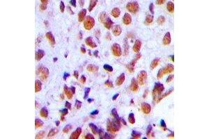 Immunohistochemical analysis of RAD21 staining in human breast cancer formalin fixed paraffin embedded tissue section. (RAD21 anticorps  (C-Term))