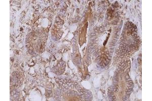 Immunohistochemistry staining of colorectal carcinoma (paraffin-embedded sections) with anti-human CD66e (CB30). (CEACAM5 anticorps)