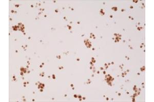 ICC testing of FFPE human 22RV1 cells (prostate carcinoma) with recombinant Androgen Receptor antibody at 1:2500.