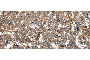 Immunohistochemistry of paraffin-embedded Human liver cancer tissue using PIWIL2 Polyclonal Antibody at dilution of 1:30(x200) (PIWIL2 anticorps)