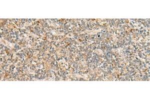 Immunohistochemistry of paraffin-embedded Human tonsil tissue using TBCK Polyclonal Antibody at dilution of 1:25(x200) (TBCK anticorps)