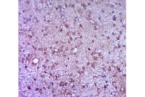 Paraformaldehyde-fixed, paraffin embedded human brain glioma, Antigen retrieval by boiling in sodium citrate buffer (pH6. (G-CSF anticorps  (AA 155-198))