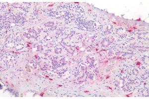 Detection of TPS in Human Mast cells of Breast Tissue using Polyclonal Antibody to Tryptase (TPS)