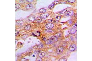 Immunohistochemical analysis of Caspase 9 staining in human lung cancer formalin fixed paraffin embedded tissue section. (Caspase 9 anticorps  (Center))