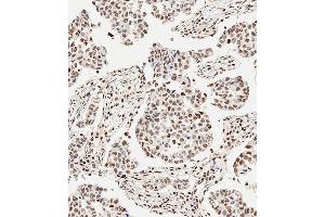 Immunohistochemical analysis of paraffin-embedded Human breast carcinoma tissue using (ABIN6243675 and ABIN6577401) performed on the Leica® BOND RXm. (GLI2 anticorps  (C-Term))