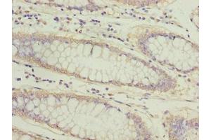 Immunohistochemistry of paraffin-embedded human colon cancer using ABIN7144813 at dilution of 1:100 (ATL2 anticorps  (AA 1-300))