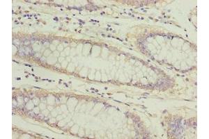 Immunohistochemistry of paraffin-embedded human colon cancer using ABIN7144813 at dilution of 1:100 (ATL2 anticorps  (AA 1-300))