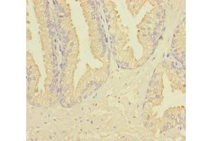 Immunohistochemistry of paraffin-embedded human prostate cancer using ABIN7167274 at dilution of 1:100 (RAB27B anticorps  (AA 1-218))
