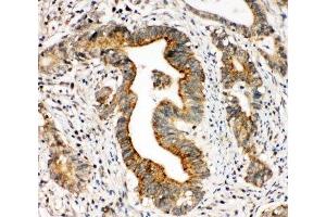 IHC-P: Integrin alpha 3 antibody testing of human intestinal cancer tissue
