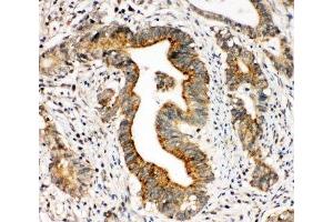 IHC-P: Integrin alpha 3 antibody testing of human intestinal cancer tissue (ITGA3 anticorps  (N-Term))