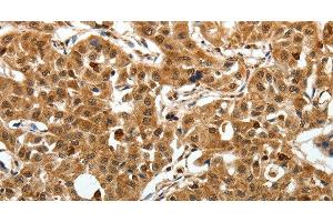 Immunohistochemistry of paraffin-embedded Human lung cancer using SOX-13 Polyclonal Antibody at dilution of 1:50 (SOX13 anticorps)