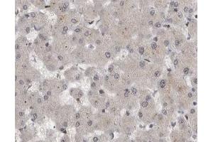 ABIN6267594 at 1/200 staining human liver cancer tissue sections by IHC-P.