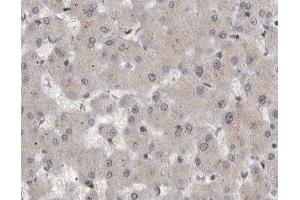ABIN6267594 at 1/200 staining human liver cancer tissue sections by IHC-P. (MEK1 anticorps  (pSer221))