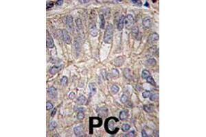 Formalin-fixed and paraffin-embedded human prostate carcinoma tissue reacted with CDH3 polyclonal antibody  , which was peroxidase-conjugated to the secondary antibody, followed by DAB staining. (P-Cadherin anticorps  (C-Term))
