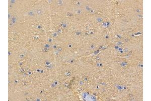 ABIN6261423 and ABIN6272638 at 1/100 staining human glioblastoma by IHC-P. (ECM1 anticorps  (C-Term))