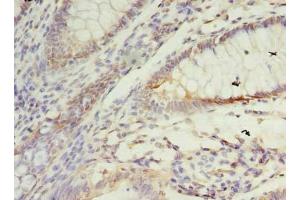 Immunohistochemistry of paraffin-embedded human colon cancer using ABIN7172922 at dilution of 1:100 (SSR3 anticorps  (AA 77-135))