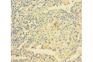 Immunohistochemistry of paraffin-embedded human lung cancer using ABIN7175481 at dilution of 1:100 (VAMP5 anticorps  (AA 1-72))