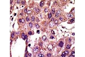 IHC analysis of FFPE human hepatocarcinoma stained with the AMFR antibod (AMFR anticorps  (AA 571-601))