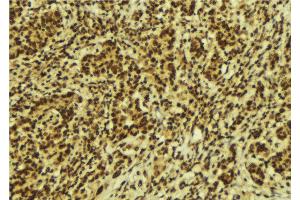 ABIN6274165 at 1/100 staining Human breast cancer tissue by IHC-P. (Topoisomerase II alpha anticorps  (Internal Region))
