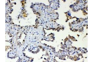 IHC testing of FFPE human lung cancer tissue with ETV6 antibody at 1ug/ml. (ETV6 anticorps)