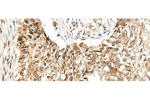 Immunohistochemistry of paraffin-embedded Human lung cancer tissue using CCDC181 Polyclonal Antibody at dilution of 1:50(x200) (C1orf114 anticorps)
