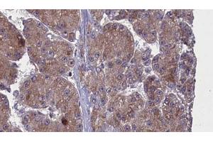 ABIN6272762 at 1/100 staining Human liver cancer tissue by IHC-P. (OR52N2 anticorps  (C-Term))