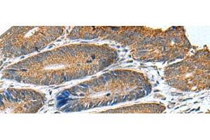 Immunohistochemistry of paraffin-embedded Human colorectal cancer tissue using HSD11B1 Polyclonal Antibody at dilution of 1:70(x200) (HSD11B1 anticorps)