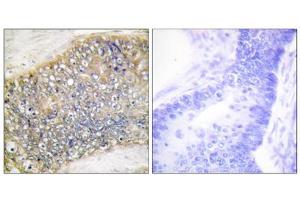 Immunohistochemistry analysis of paraffin-embedded human colon carcinoma tissue using TALL-2 antibody. (TNFSF13 anticorps  (Internal Region))