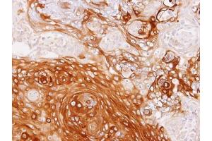 IHC-P Image Immunohistochemical analysis of paraffin-embedded SCC4 xenograft, using GBP1, antibody at 1:100 dilution.