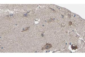 ABIN6275980 at 1/100 staining Human brain cancer tissue by IHC-P. (CNR1 anticorps  (N-Term))