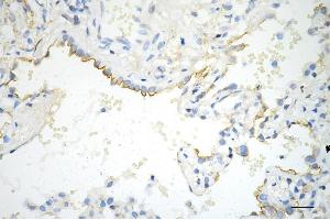 Immunohistochemistry was performed on paraffin-embedded human lung adenocarcinoma using phospho-EGFR (Y) antibody (ABIN7798468), 1:200).