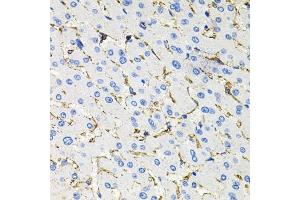Immunohistochemistry of paraffin-embedded human liver damage using Somatostatin Receptor 2 (SSTR2) antibody (ABIN3017442, ABIN3017443, ABIN3017444 and ABIN6220093) at dilution of 1:100 (40x lens).