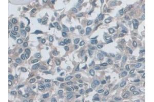 Detection of MHCB in Human Liver cancer Tissue using Polyclonal Antibody to Major Histocompatibility Complex Class I B (MHCB)