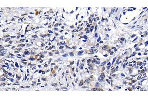 Detection of ATM in Human Ovarian cancer Tissue using Polyclonal Antibody to Ataxia Telangiectasia Mutated (ATM)