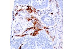 Formalin-fixed, paraffin-embedded human Colon Carcinoma stained with Nestin Mouse Monoclonal Antibody (NES/2911).