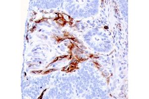 Formalin-fixed, paraffin-embedded human Colon Carcinoma stained with Nestin Mouse Monoclonal Antibody (NES/2911). (Nestin anticorps  (AA 698-844))